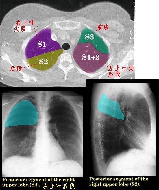 jp0020:右肺叶