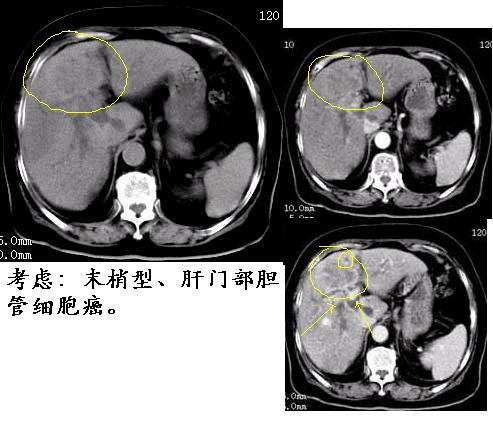 肝胆管细胞癌