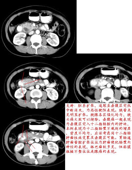 ct病例 69 肝,脾,胰腺 69 查看内容 病理结果是:胰头壶腹部癌