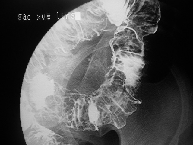 cl0162小肠克罗恩病