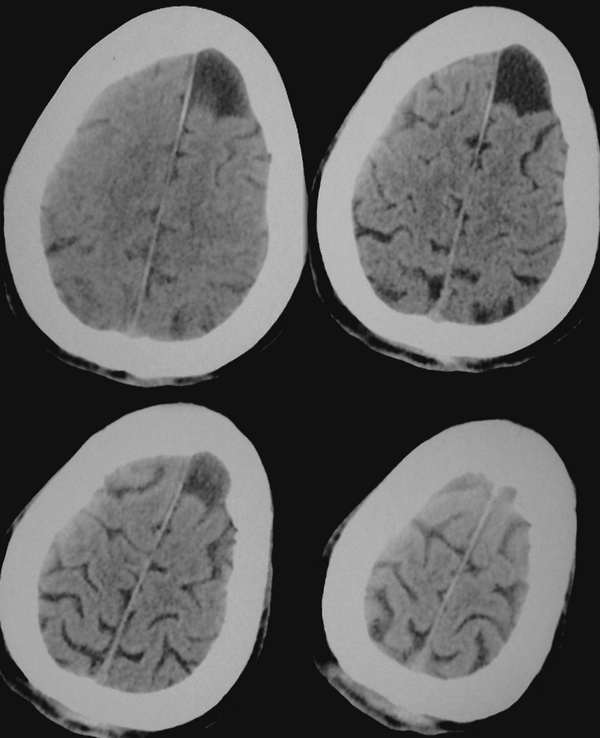 ct2188:[讨论] 左顶蛛网膜囊肿? 形成原因