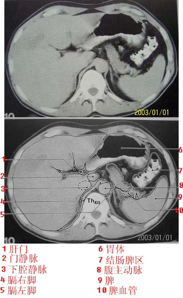 jp-0169a:上腹部ct解剖