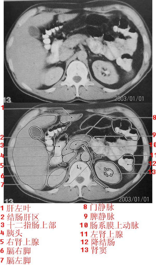 jp0169a上腹部ct解剖