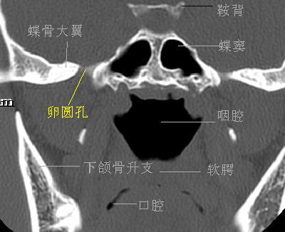 鼻窦卵圆孔层面