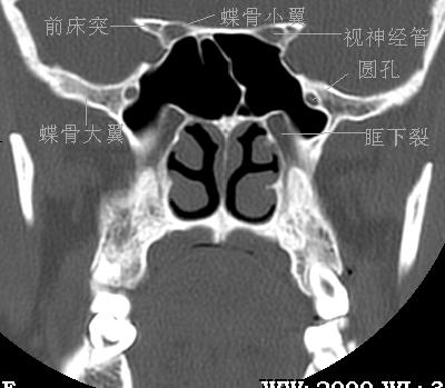 jp0170:鼻窦冠状hrct解剖