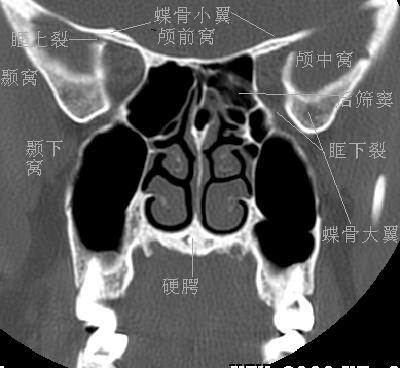 jp0170:鼻窦冠状hrct解剖