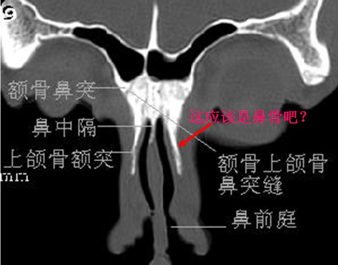 jp0170:鼻窦冠状hrct解剖