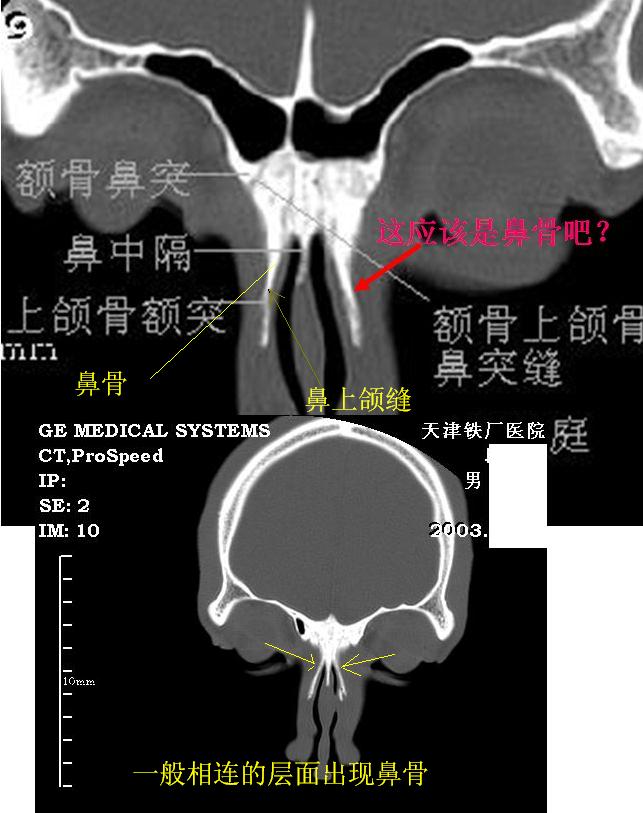 jp0170:鼻窦冠状hrct解剖 - 影像解剖 医影在线