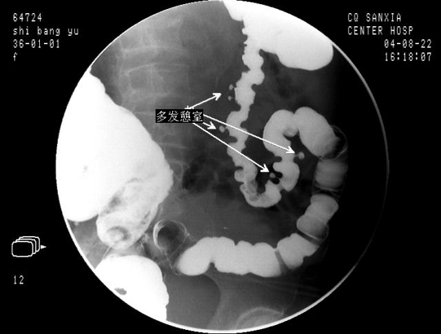 zt0024消化道钡餐大肠篇