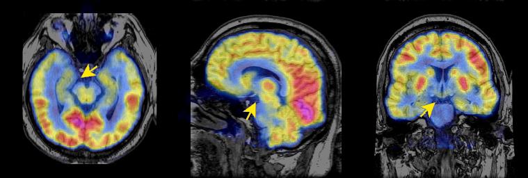 jp112-027:mri--动眼神经