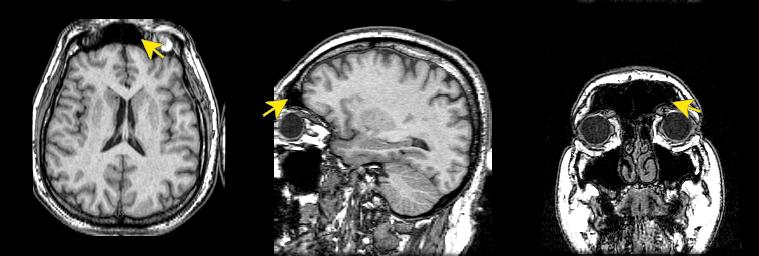 jp112-028:mri--额窦 - 影像解剖 医影在线