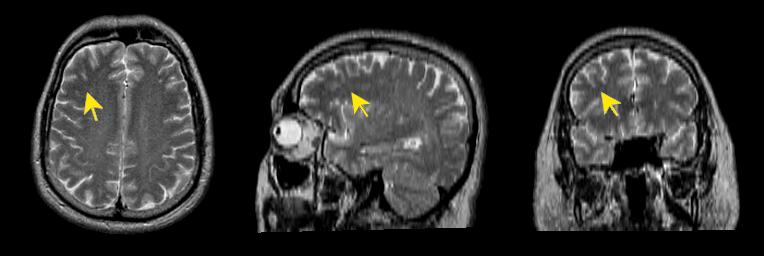 jp112-033:mri--放射冠