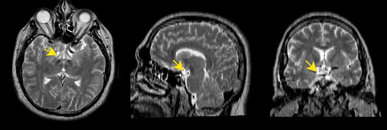 jp112-034:mri-海绵窦