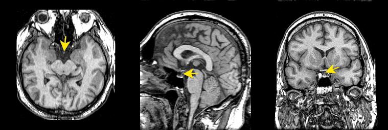 jp112-044:mri--漏斗管(垂体的茎部)