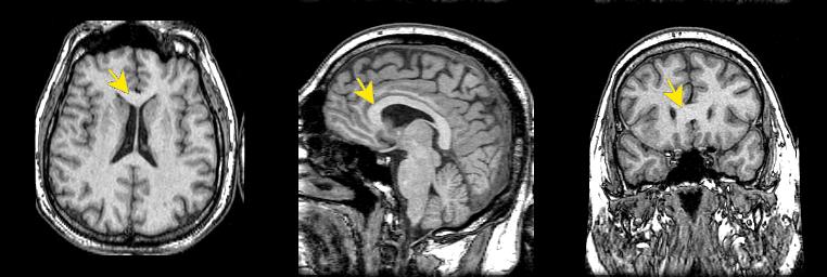 jp112-056:mri--胼胝体膝部 - 影像解剖 医影在线