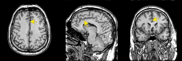 jp112-058:mri--前扣带回 - 影像解剖 医影在线