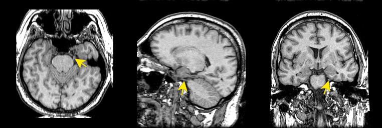 jp112-066:mri--三叉神经 - 影像解剖 医影在线