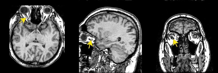 jp112-077:mri--视神经 - 影像解剖 医影在线