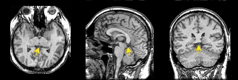 jp112-081:mri--松果体 - 影像解剖 医影在线