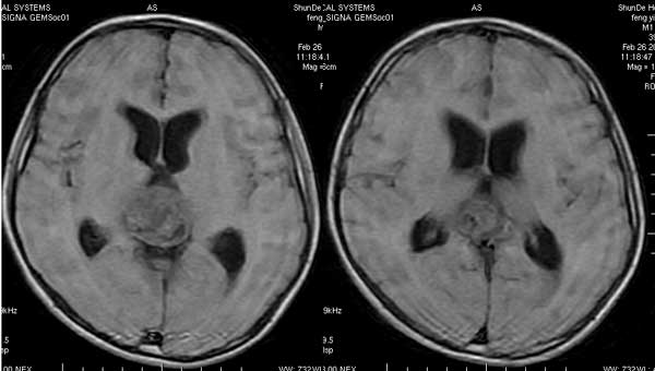 mri病例 69 中枢神经系统 69 查看内容   手术所见:于第三脑室顶