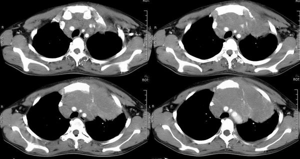 ct1425:纵隔肿瘤(有病理结果)