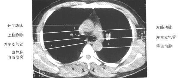 jp0132:[转帖]正常纵隔及肺部ct解剖图片