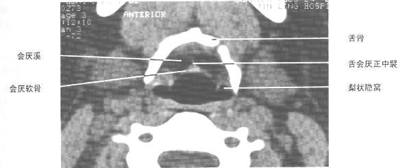 jp0134:[转帖]正常喉部ct图谱 - 影像解剖 医影在线