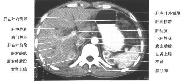 jp0135:[转帖]正常腹部ct解剖图谱