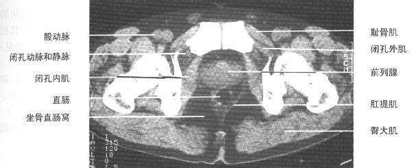 jp0136:[转帖]正常盆腔ct解剖图谱