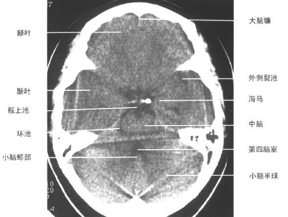 jp0137:[转帖]正常颅脑ct断层图谱 - 影像解剖 医影