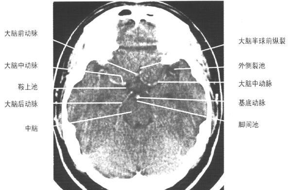 jp0137:[转帖]正常颅脑ct断层图谱 - 影像解剖 医影在线