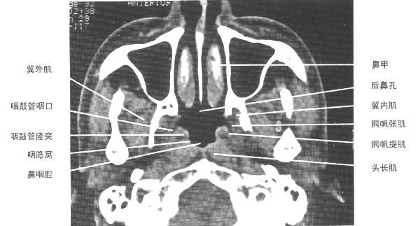 jp0126:[转帖]鼻咽鼻窦部ct断层图 - 影像解剖 医影