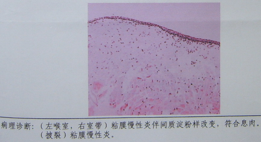 ct病例 69 咽部 69 查看内容   考虑非肿瘤--肉芽肿性疾病,结核