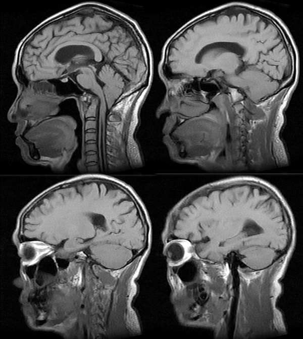 mri0316:颅脑畸形,典型病例!