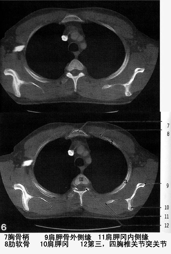 jp-0184a胸部ct解剖(骨窗)