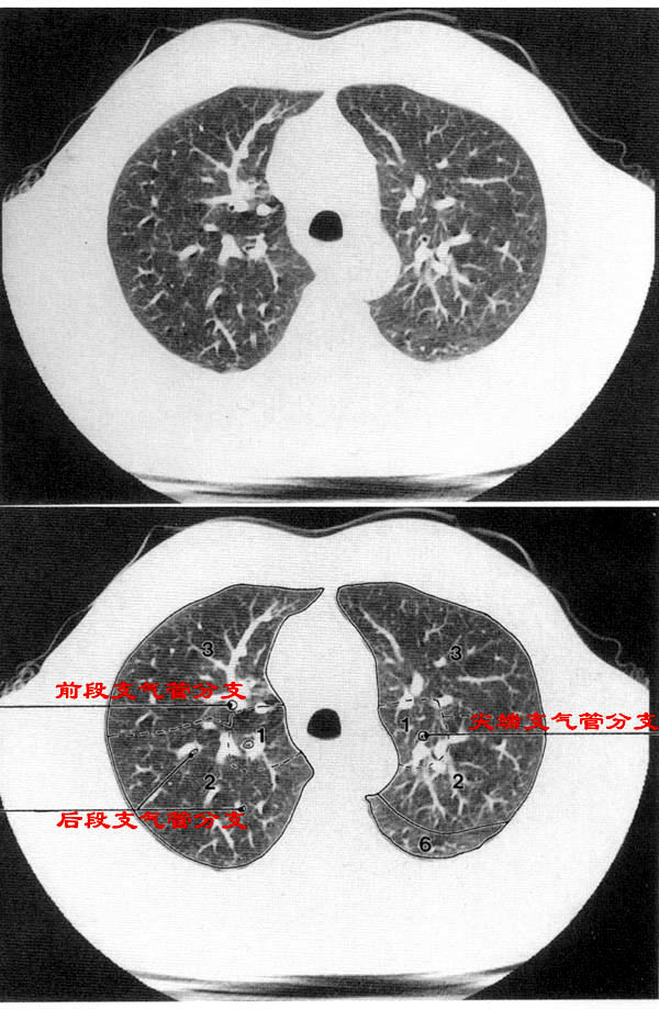 jp-0184c胸部ct解剖(肺窗)