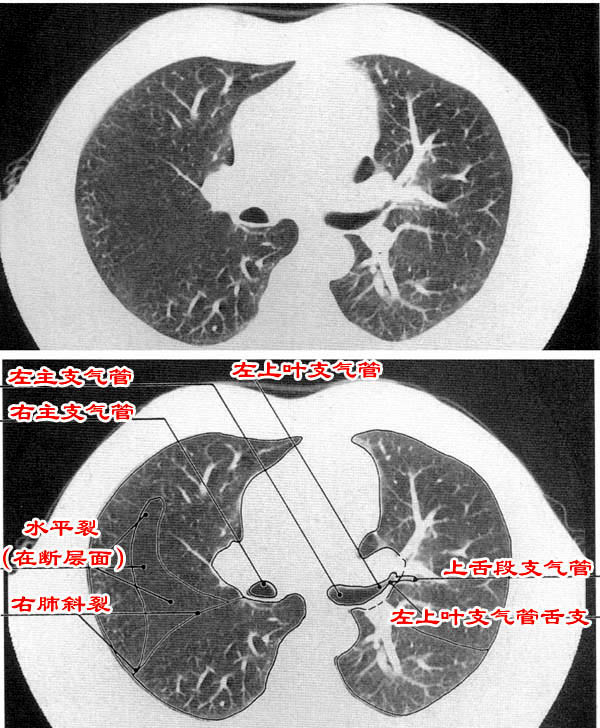 jp-0184c胸部ct解剖(肺窗)