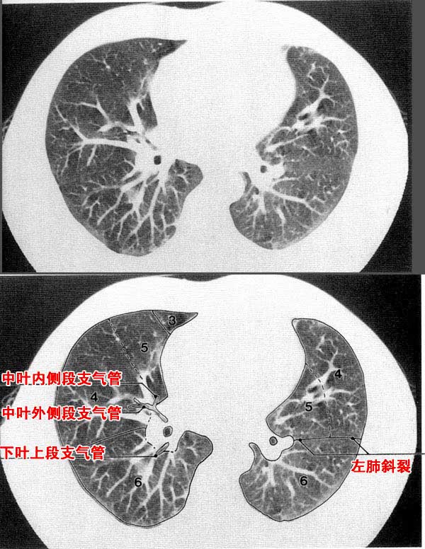 jp-0184c胸部ct解剖(肺窗)