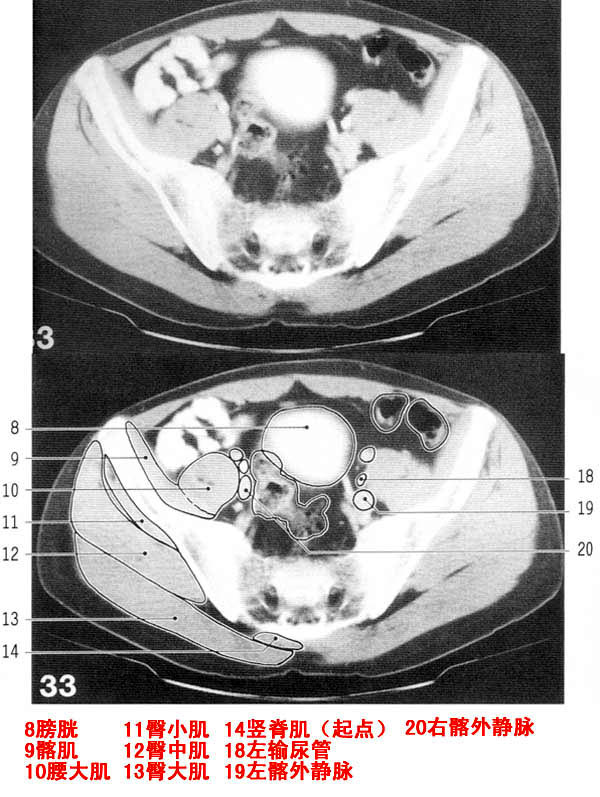 jp-0169b:中下腹部ct解剖(续上腹部)