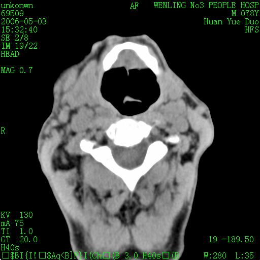 甲状软骨,舌骨周围可见多个囊状影,无明显强化,边缘较清,颈部未见