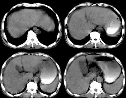 ct3934:腹部典型病例_共同学习 ct病例讨论 医影在线