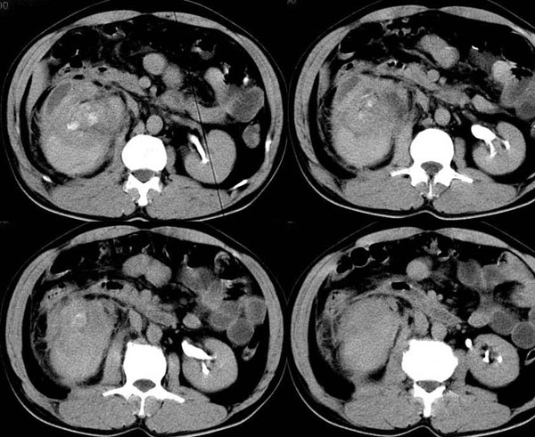 右肾自发性破裂并出血
