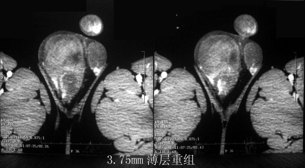 阴囊胚胎性横纹肌肉瘤