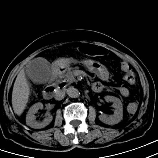 ct4751:十二指肠乳头旁憩室,请帮助会诊.