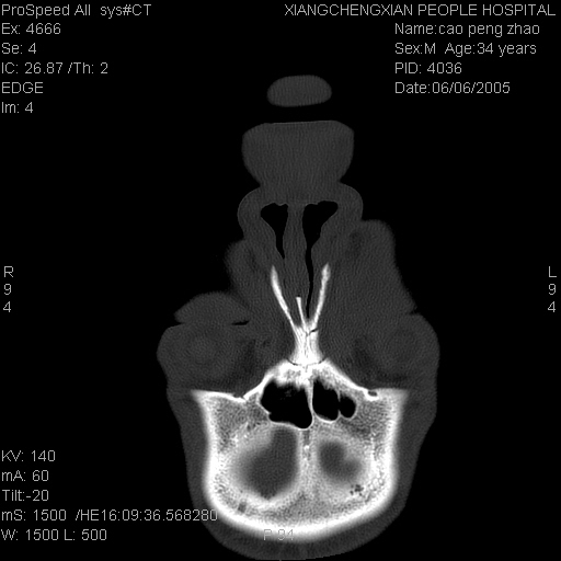 cl0136右侧鼻骨及左额突骨折