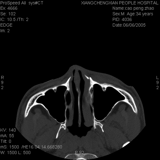 cl0136:右侧鼻骨及左额突骨折