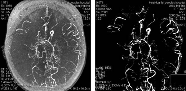 mri0539,v0097结果:烟雾病