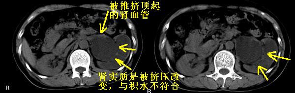 ct5595:肾脏病变