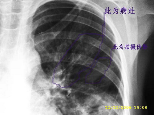 支原体肺炎