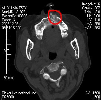 69 ct病例 69 颌面,颈部 69 查看内容[face=黑体]发现上颌骨